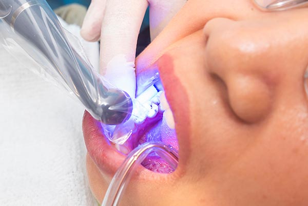 The image shows a person with a dental device, likely a drill, being used on their teeth, with a visible blue light illuminating the area of treatment.