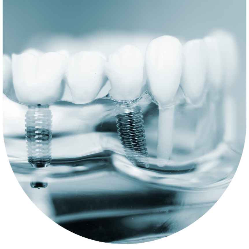 The image shows a close-up view of a dental implant assembly with a screw partially inserted into a clear plastic mold, which appears to be part of a dental prosthetic manufacturing process.