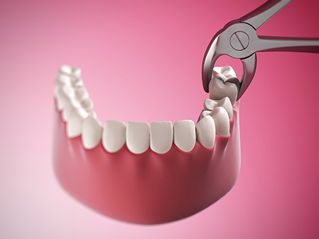 The image shows a pair of scissors with a red handle inserted into an open mouth model, demonstrating the process of dental implant placement.