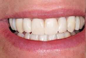 The image shows a person with a broad smile displaying white teeth, taken from a close-up angle.