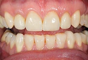 The image shows a close-up view of a person s teeth with a focus on the lower front teeth, which appear yellowed and stained. The person has a partial smile, revealing multiple teeth with varying degrees of discoloration. There are no visible texts or distinguishing marks in the image that provide additional context.