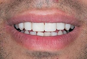 The image shows a close-up of a person s face with a wide smile, revealing teeth and lips, against a gray background.