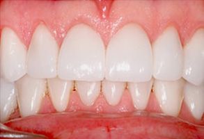 The image displays a close-up view of a person s teeth with a focus on their front teeth, which have undergone cosmetic dental treatment, such as veneers or whitening, resulting in a bright and uniform appearance.
