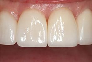The image shows a close-up view of a person s teeth with a focus on a large cavity or dental work, highlighting the need for dental care and maintenance.