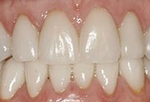 The image shows a close-up view of a person s teeth with a focus on the front teeth, which are prominent due to their size and positioning.