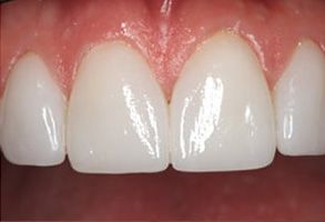 The image shows a close-up of a person s teeth with a focus on an area where a tooth has been restored, likely with a dental implant, given its distinct shape and color compared to the surrounding natural teeth.