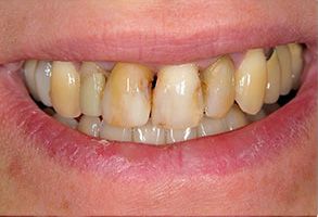 The image shows a person with a wide smile displaying yellowed teeth and a red lipstick mark on their lower lip, with a focus on their mouth and teeth.