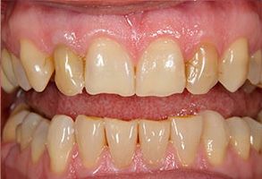 The image shows two close-up photographs of an individual s teeth with visible staining and discoloration, which suggests poor oral hygiene or dental issues.