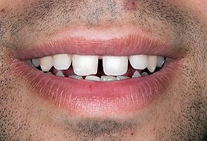The image shows a close-up of a person s face with a big smile displaying multiple teeth, including a prominent front tooth with a gap between two teeth on either side.