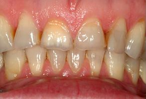 The image displays two close-up photographs of a person s teeth with yellowing and staining, showing both upper and lower sets of teeth with visible decay and discoloration.
