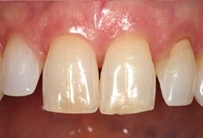 The image displays a close-up view of a person s teeth with a focus on a large gap between two front teeth, which appear to be missing or extracted, set against a background that suggests a dental office environment.