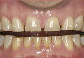 The image shows a person s mouth with yellowed teeth and a metal wire across the front teeth, suggesting dental work or orthodontic treatment.