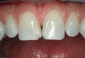 The image shows a close-up view of a person s teeth with visible dental work, including a large gap between two front teeth, which appear to be veneers or caps, and possibly some other dental procedures such as braces or aligners.